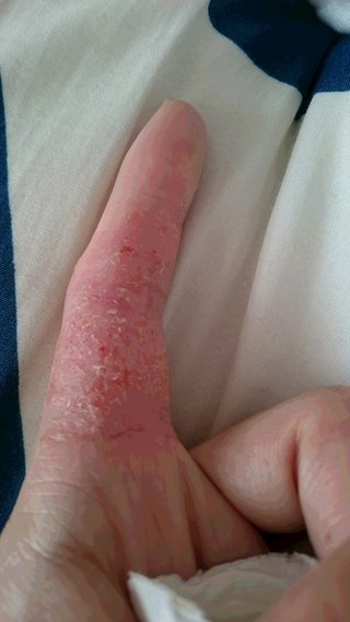 主婦湿疹【汚写あり】