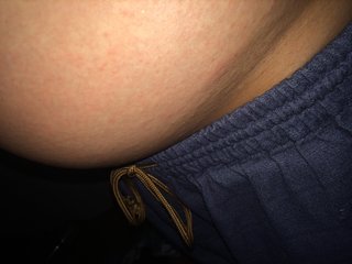 蕁麻疹？（汚い写真あり苦手な方はみないでください）