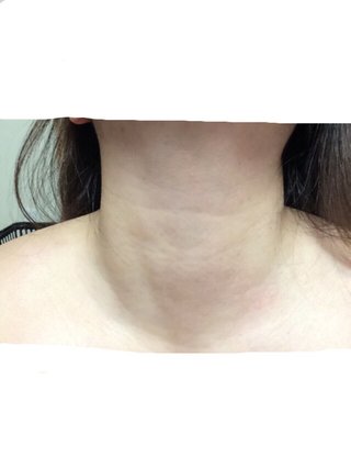 甲状腺のトピみて心配になった（写真あり）