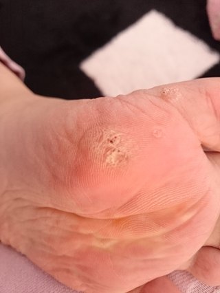 これって魚の目？キモいけど写メあり