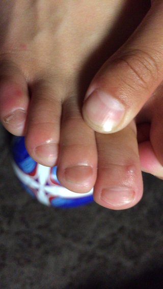 足のイボ。写メあり
