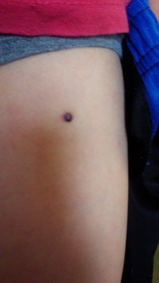 ホクロ？（写あり）