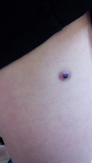 ホクロ？（写あり）