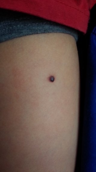 ホクロ？（写あり）