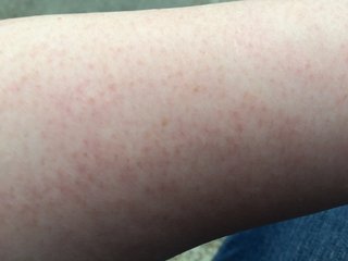 腕の毛穴が一年中赤い