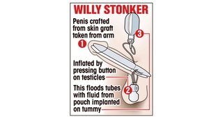 ペニス失った男性、ボタンで勃起する人工ペニスの形成手術に成功。