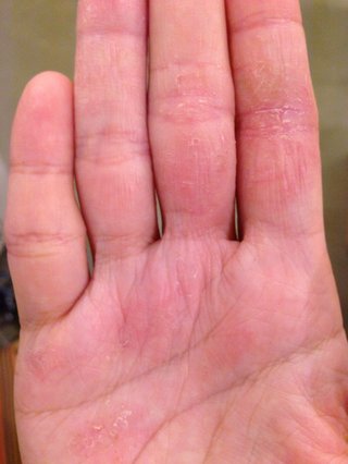手湿疹・主婦湿疹