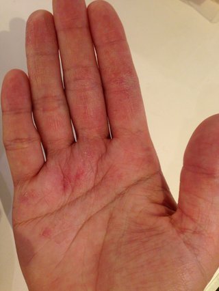 手湿疹・主婦湿疹