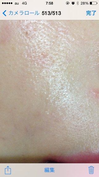 助けてください。肌が汚い。注意画像あり