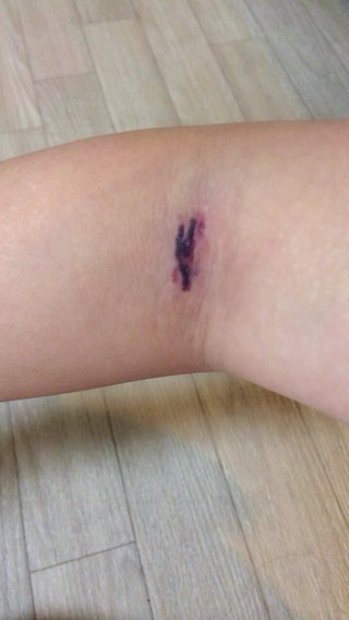 今日採血して絆創膏みたいなの貼られて