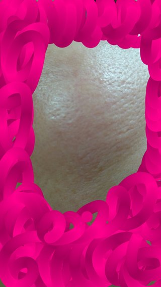 35才毛穴(写真あり)