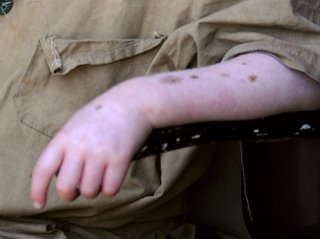 【アルビノ狩り】アフリカで5歳女児を殺害