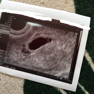 胎芽はいつ確認出来る