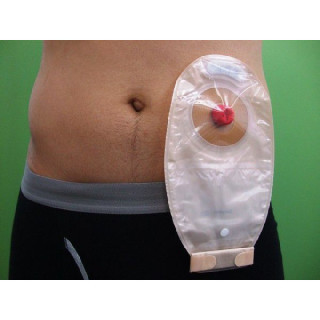 人工肛門をつけた人、入浴拒否される…支援団体「入浴中に排便しても便袋にたまるので問題ない」