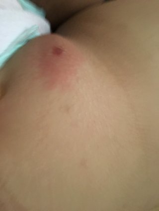 閲覧注意 湿疹？