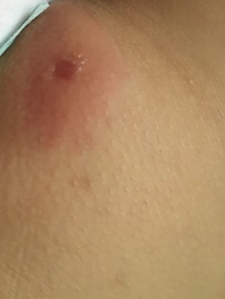 閲覧注意 湿疹？