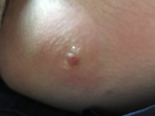 閲覧注意 湿疹？