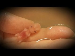 中絶手術 笑気麻酔  激痛