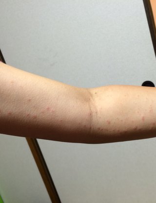 腕に赤い湿疹