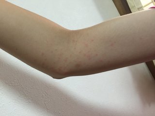 腕に赤い湿疹