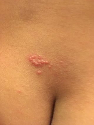 2歳 お尻にブツブツ