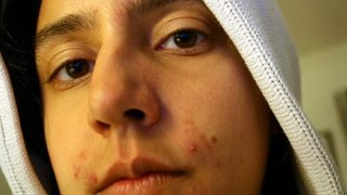 【科学】高校時代にニキビができまくった肌は、大人になってから若々しい肌になる