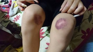 娘が原付バイクに当て逃げされたらしい。