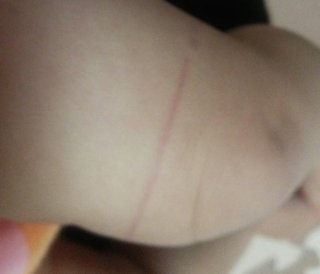 1歳3か月の娘の左足に赤い線が消えません