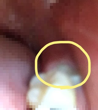 【歯医者怖い】親知不・虫歯【勇気を下さい】