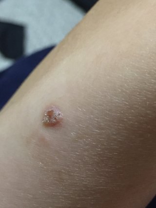 イボ【※注意※写真あり】