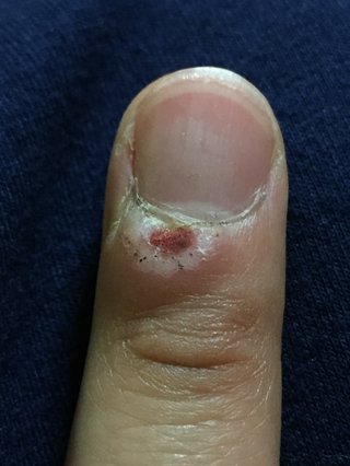 イボ【※注意※写真あり】