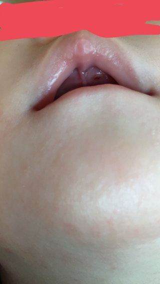 子供の歯茎の血。これは病院いくべき？