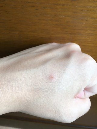 虫刺され これ、何ですか？【写真有り】