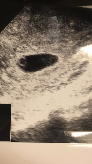 胎芽？？双子？？