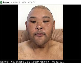 HIROが休養　高血圧による「左脳室内出血」で入院