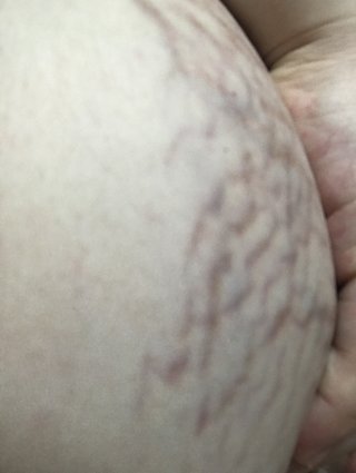 胸の妊娠線