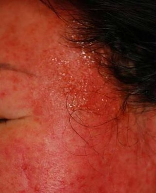 本当は怖い！ヘアカラーによる「接触皮膚炎」　原因に気づかず繰り返し…重症化も