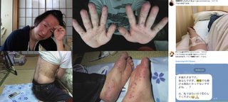 有名ニコ生主、梅毒に感染してしまう 