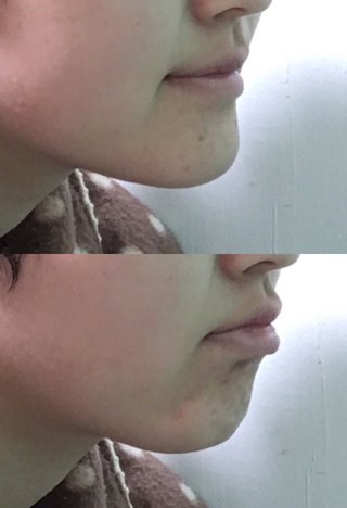 顎がしゃくれてるの改善した方が良い？