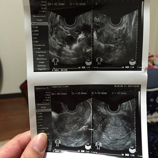 検査薬では陽性がでました。長文です。