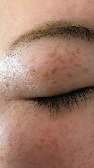 そばかすって気持ち悪いですか？