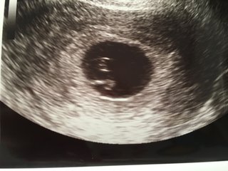 稽留流産…もう諦めるしかありませんでしょうか？