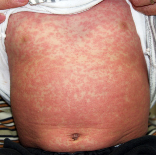 名古屋で「はしか」新たに２人女子中学生