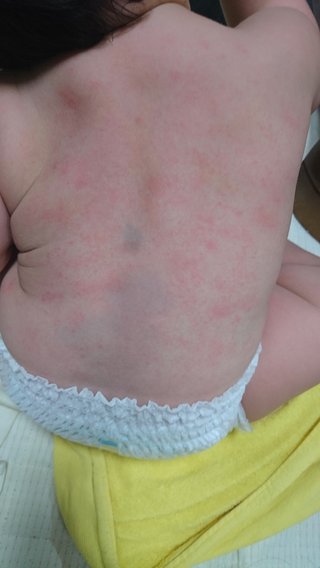 これって蕁麻疹？！