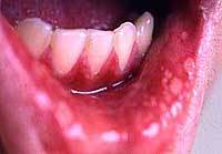 名古屋で「はしか」新たに２人女子中学生