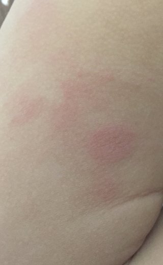 2歳、カサカサした赤くて丸い湿疹？