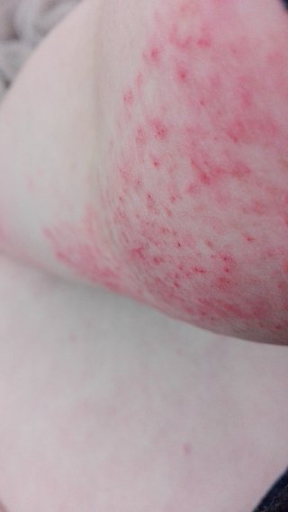 グロ注意　帯状疱疹