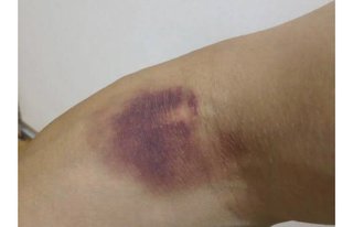 木村拓哉に遭遇。腕が紫に腫れてる