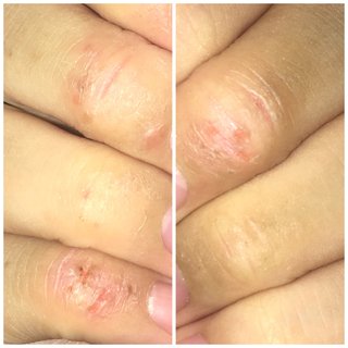 主婦湿疹荒れすぎて指が曲がらない