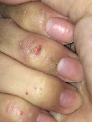 主婦湿疹荒れすぎて指が曲がらない